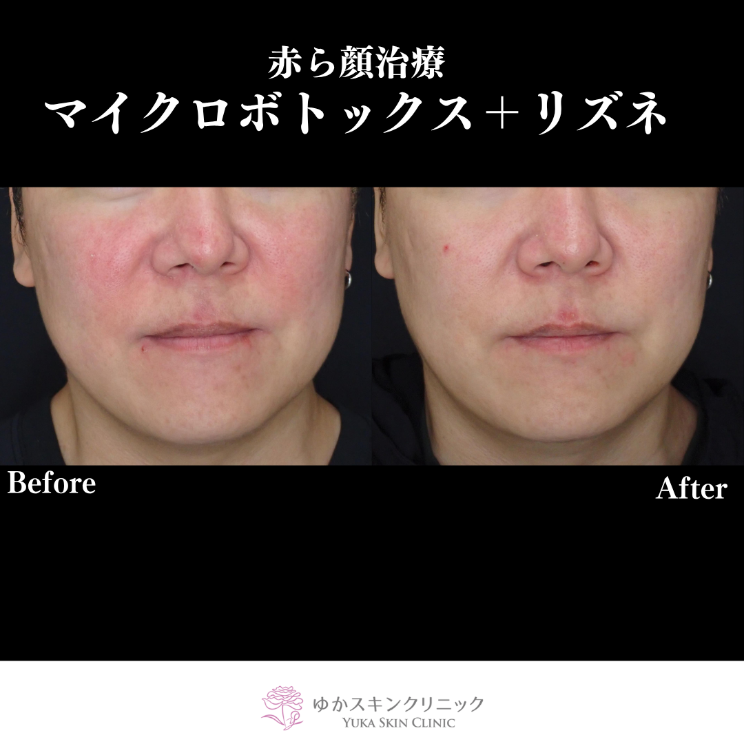 マイクロボトックス＋LIZNE