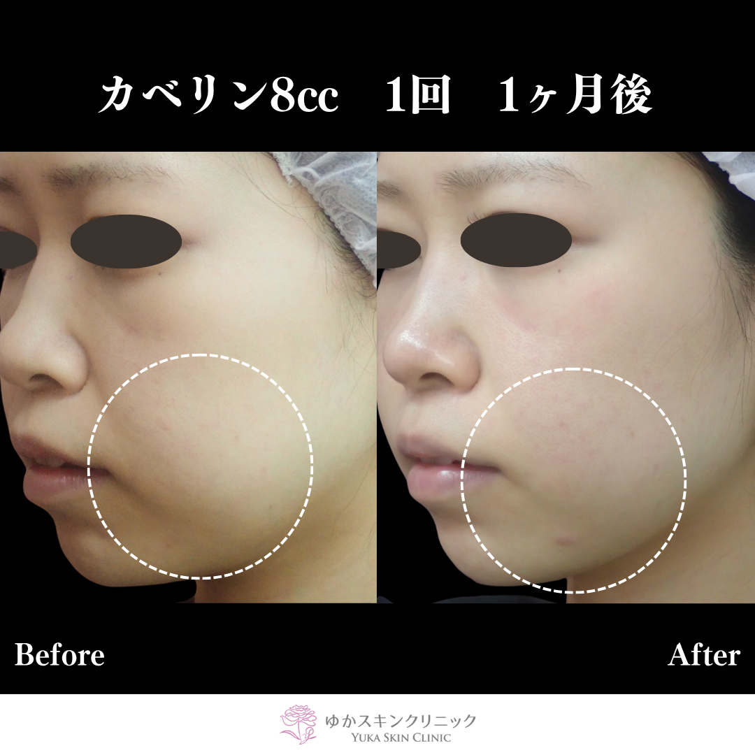 脂肪溶解注射（カベリン）