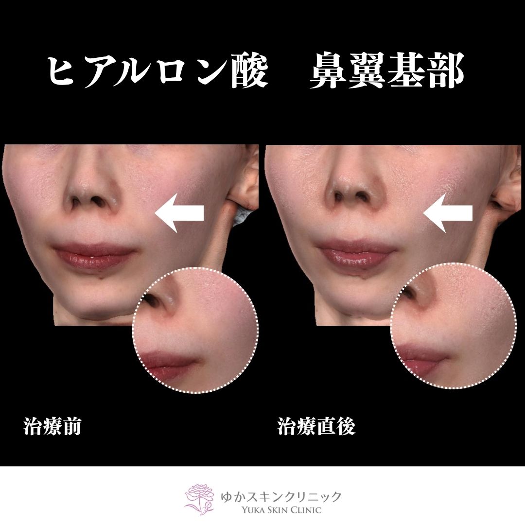 ヒアルロン酸　鼻翼基部