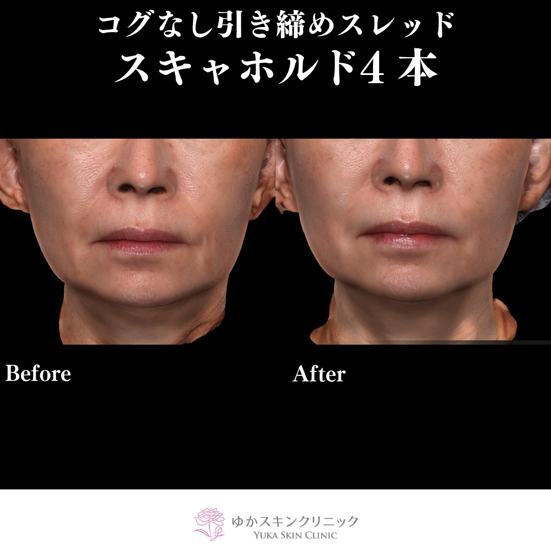 Nスキャホルド（コグなしスレッド）