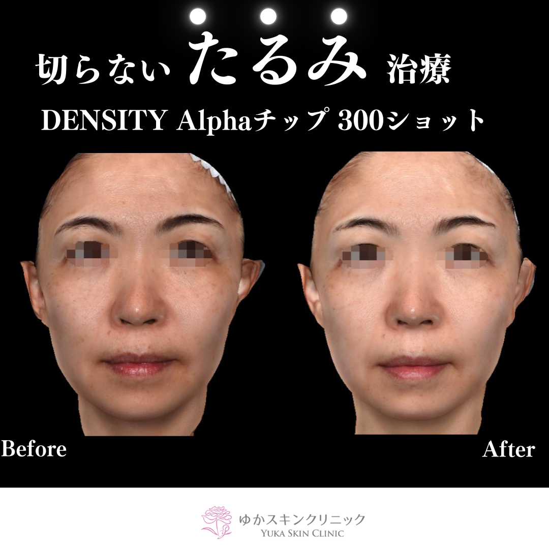 DENSITY Alphaチップ３００ショット