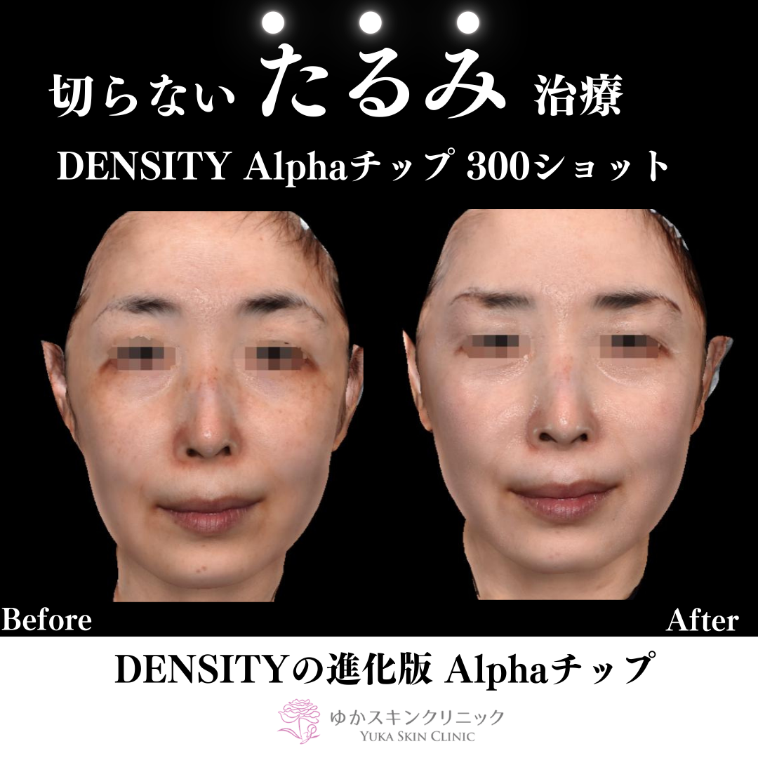 DENSITY Alphaチップ