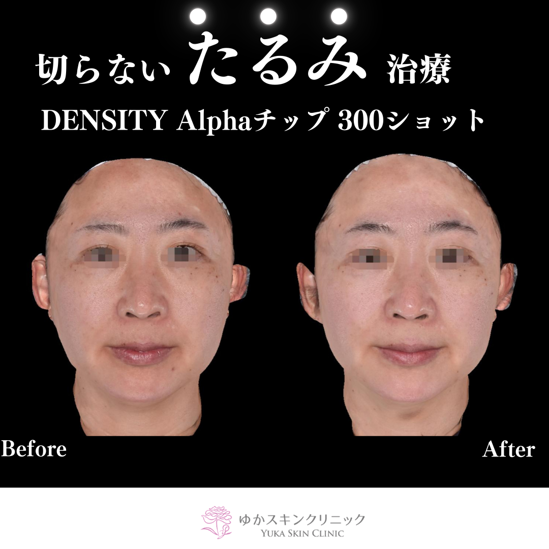 DENSITY Alphaチップ